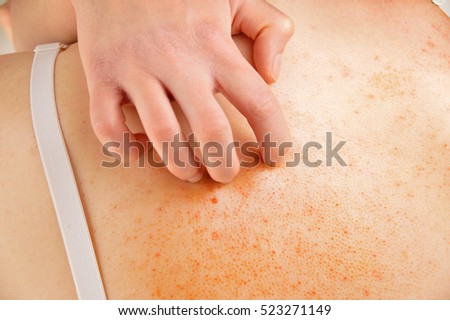 Health problem. Young woman scratching her itchy back with allergy rash