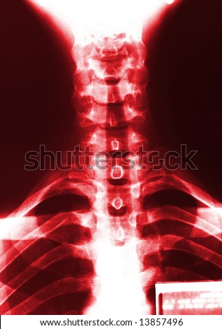 bone neck