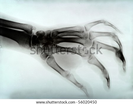 detail of hand xray medical image