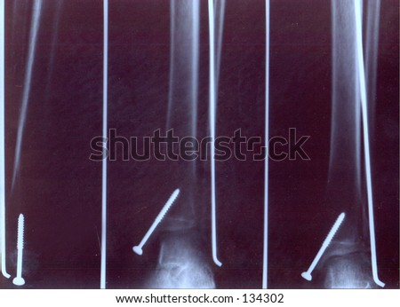 broken leg x ray. stock photo : Broken leg x ray