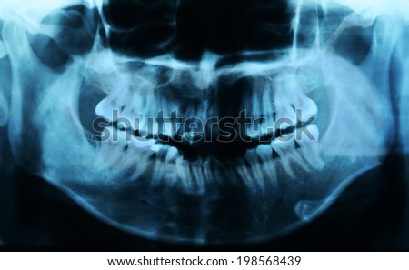 X-rays of the teeth.