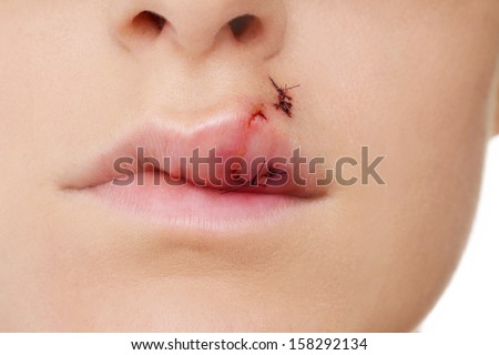 Closeup of a Bruised and Swollen Lip featuring Real Stitches