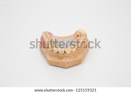 Sophisticated dental prosthesis with gold teeth, bridges and artificial teeth on a mold