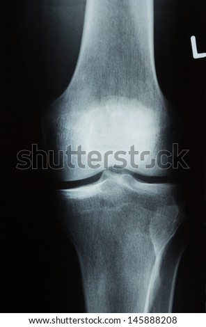X-ray photograph or RÃ?Â?Ã?Â¶ntgen image of a human knee with tibia, femur, fibula and patella