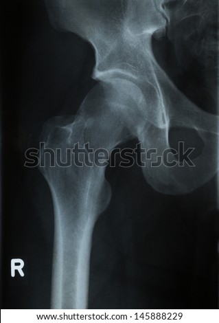 Radiology x-ray photograph of human hip