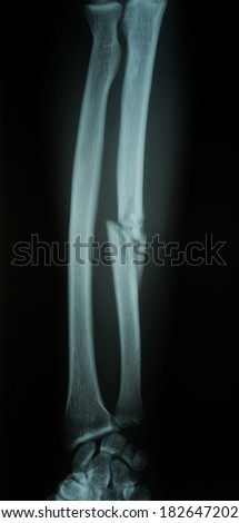 X-RAY film of ulnar bone fracture,anterior view