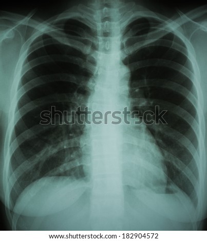 normal chest X-ray of a woman