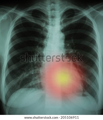 human chest X-ray with red and yellow zone of chest pain