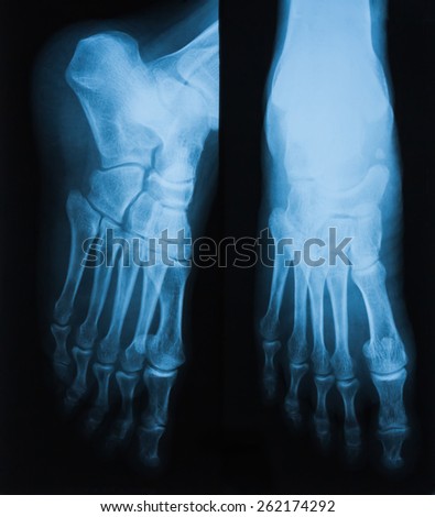 X-RAY film of foot bone