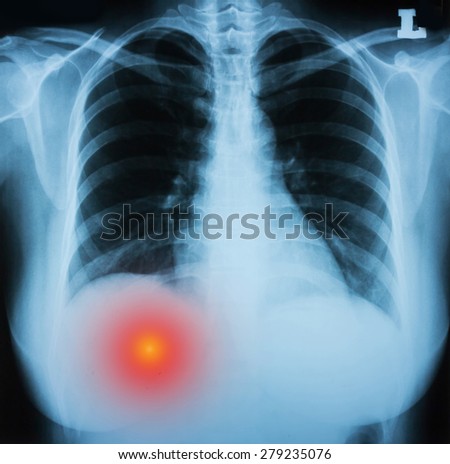 chest X-ray,chest pain