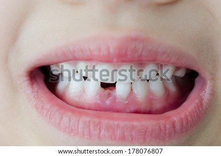 Mouth close up photography Girl broken tooth