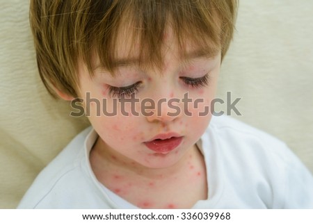 A three year old boy with chicken pox