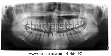 Panoramic dental X-Ray with deep dental caries tooth and big lesion