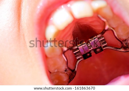 Close-up inside mouth with orthodontics equipment