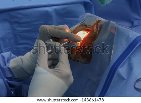 surgeons holding medical instruments and eye operate,Eye Surgery
