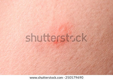 Pustule on the skin due to allergy or insect bite.