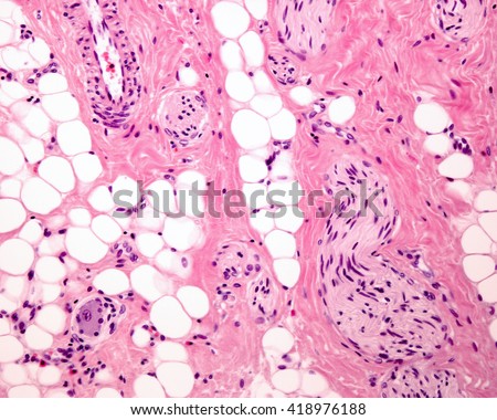 A septum of connective tissue, with numerous adipocytes (fat cells) which contain a large lipid droplet. The sinuous structures correspond to nerves. Light micrograph. Hematoxylin & eosin stain.