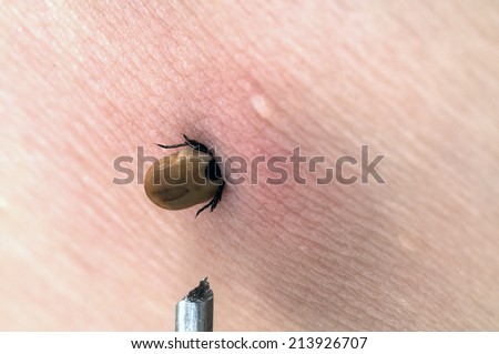 A tick (Rhipicephalus sanguineus) stuck in the arm skin in summer