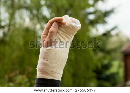 A child\'s arm in plaster