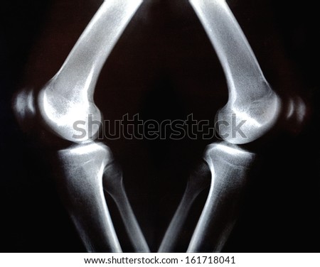 An x-ray shows large shaking joints.