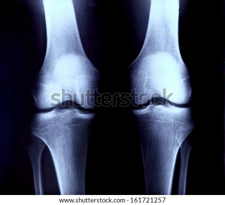 An x-ray of a pair of knee joints.