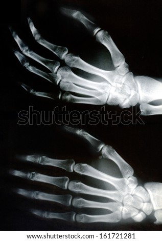 An x-ray of two hands and fingers.