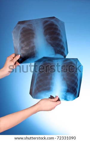 Two X-Ray Images of chest on blue background in hand