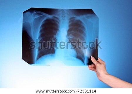 X-Ray Image of chest on blue background in hand