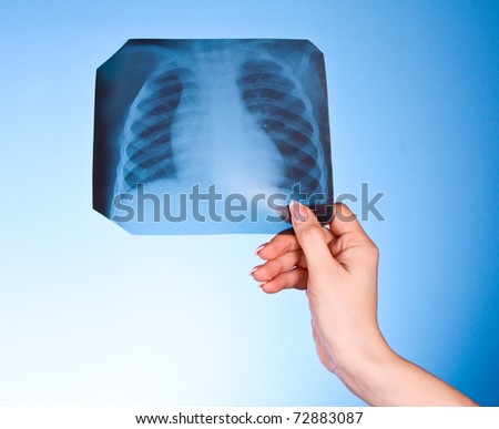 X-Ray Image of chest on blue background in hand