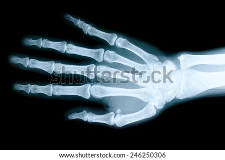 Right hand X-ray images to detect abnormalities of the hand.