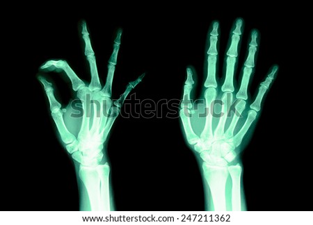 X-ray green fingers to check for irregularities in the motion of the fingers are not.