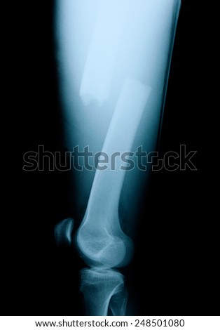 X-ray film femoral fractures. The cause of the motorcycle collided with a car.