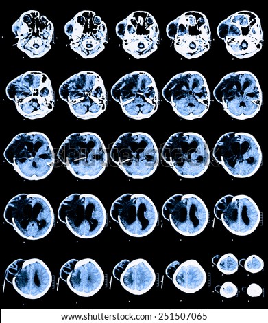 Blue Brain CT Scan image is divided into different levels. To detect abnormalities of the brain. Due to formation of oedemas area right side of ventricles brain.