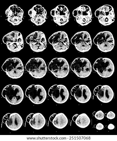 Brain CT Scan monochrome image is divided into different levels. To detect abnormalities of the brain. Due to formation of oedemas area right side of ventricles brain.