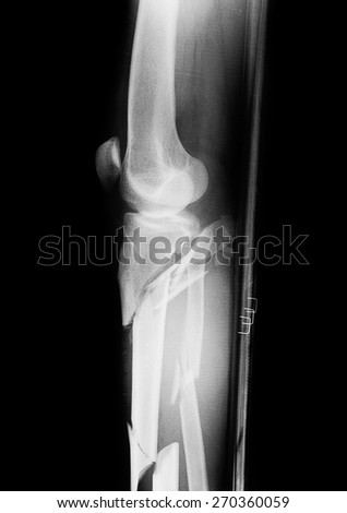 Black and white film X-ray of a broken leg bone.