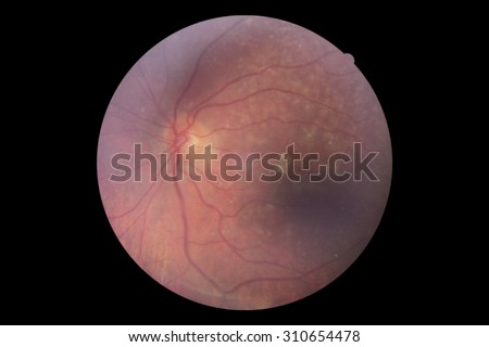 Human eye anatomy, retina, taking images with Mydriatic Retinal cameras