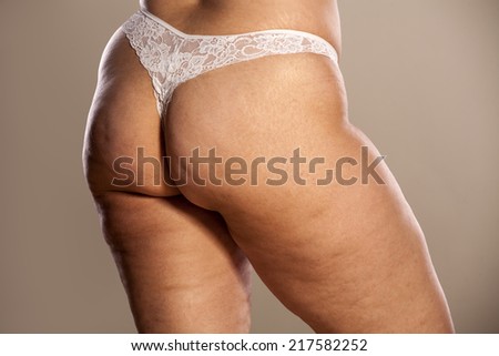 female buttocks and legs with cellulite and stretch marks