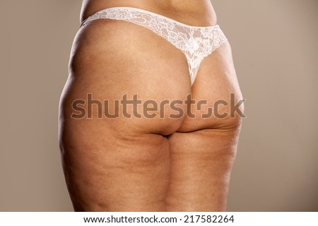 female buttocks with cellulite and stretch marks
