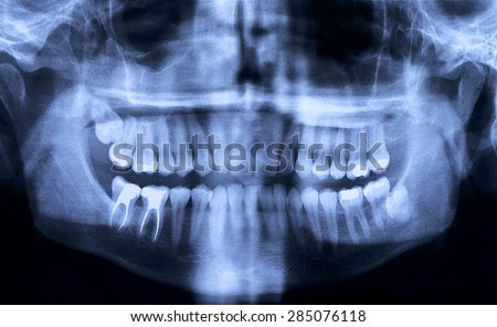 Panoramic dental X-Ray from a mouth with some tooth fillings, and a wisdom tooth crashed into a molar.