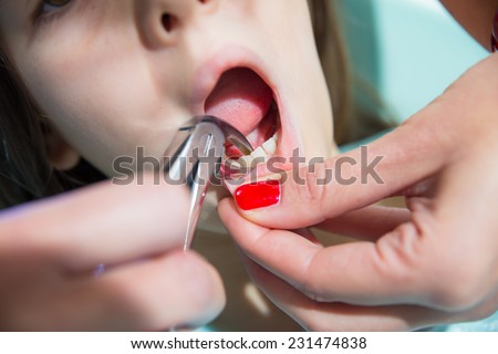 The dentist treats teeth patient, extracted tooth