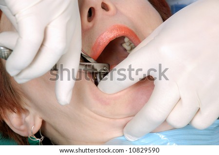 doctors hands extract a tooth from woman