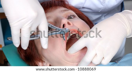 doctors hands extract a tooth from woman