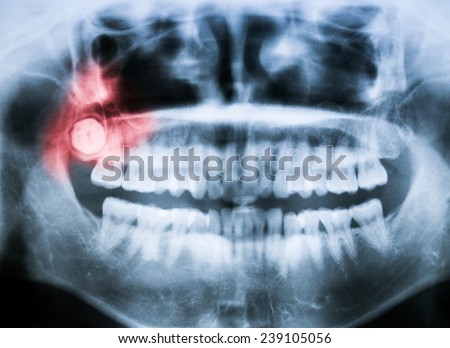 Closeup x-ray image of impacted wisdom tooth with pain abstraction in red color