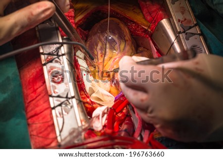 coronary artery bypass grafting probing diagonal artery