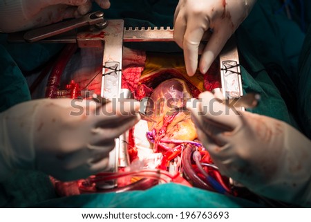 coronary artery bypass grafting open left internal mammary artery
