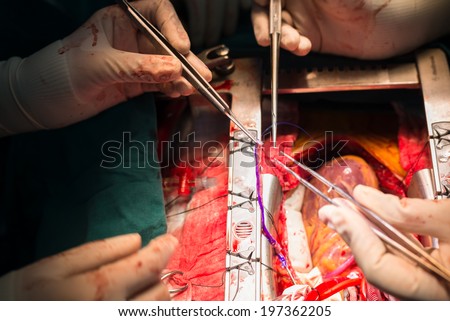 coronary artery bypass grafting diagonal artery anastomosis