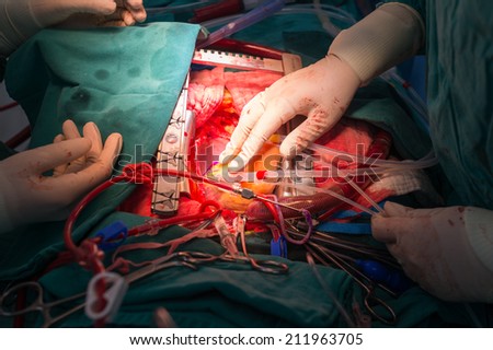 coronary artery bypass grafting