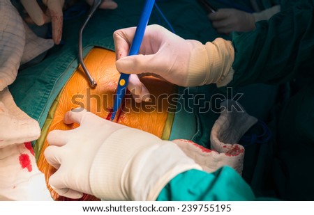 median sternotomy incision for open heart surgery
