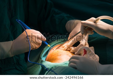 surgeon use cauterize to stop bleeding
