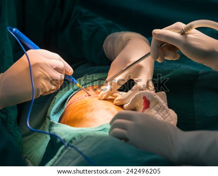 Surgeon use cauterize to stop bleeding